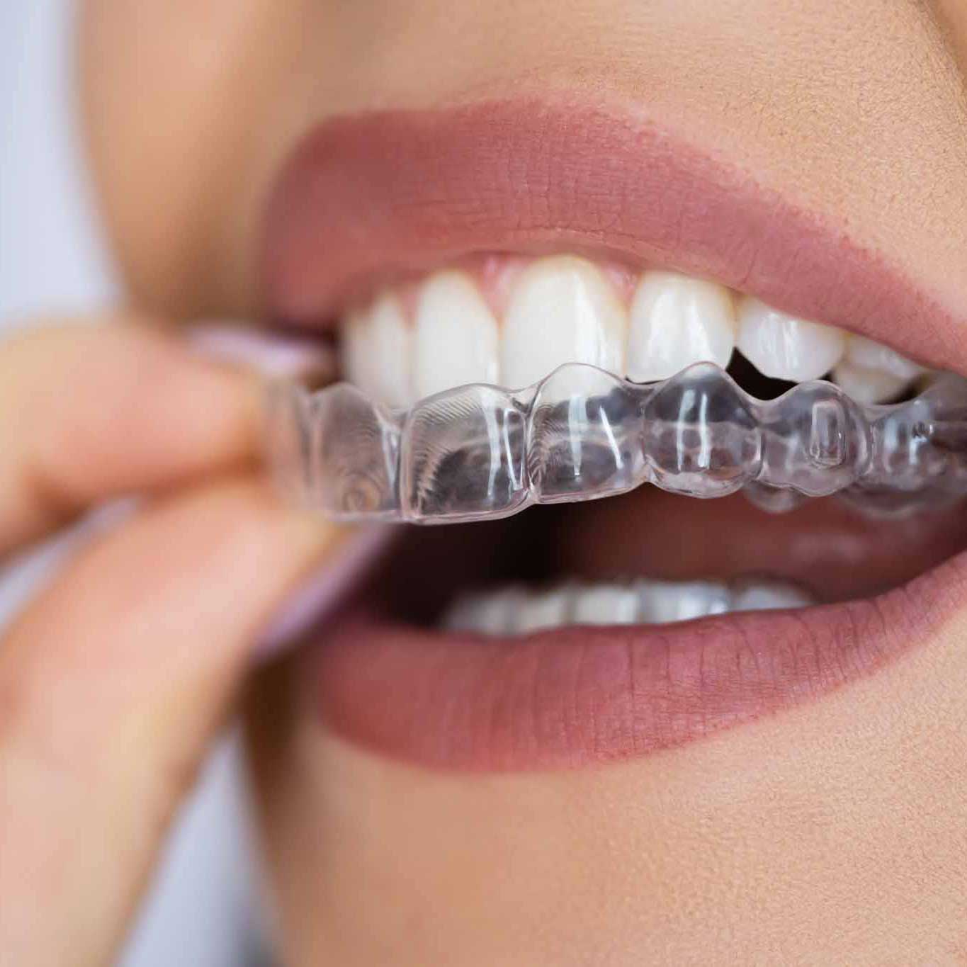 invisalign clear aligners at fairfield orthodontics in ca