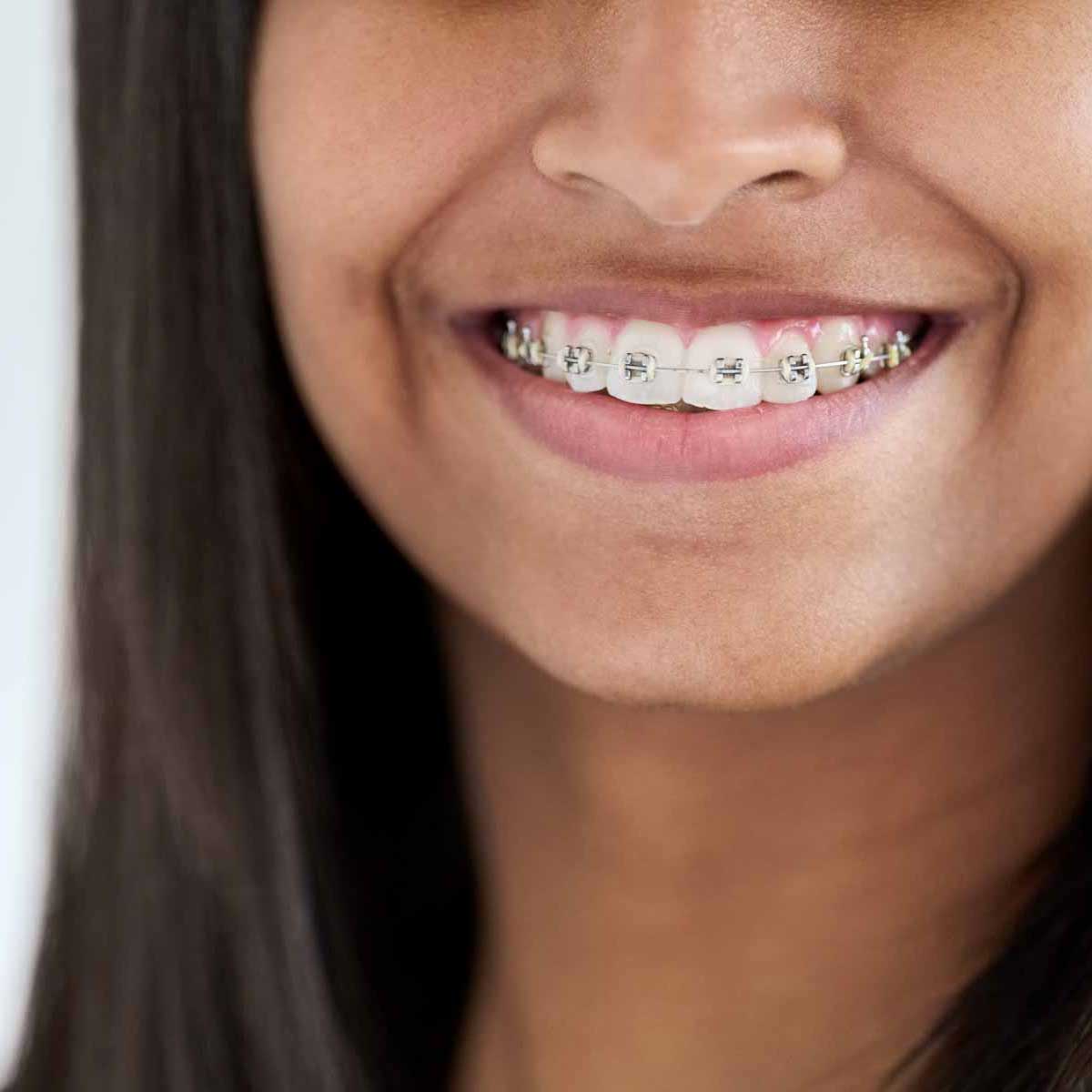 traditional braces at fairfield orthodontics in ca